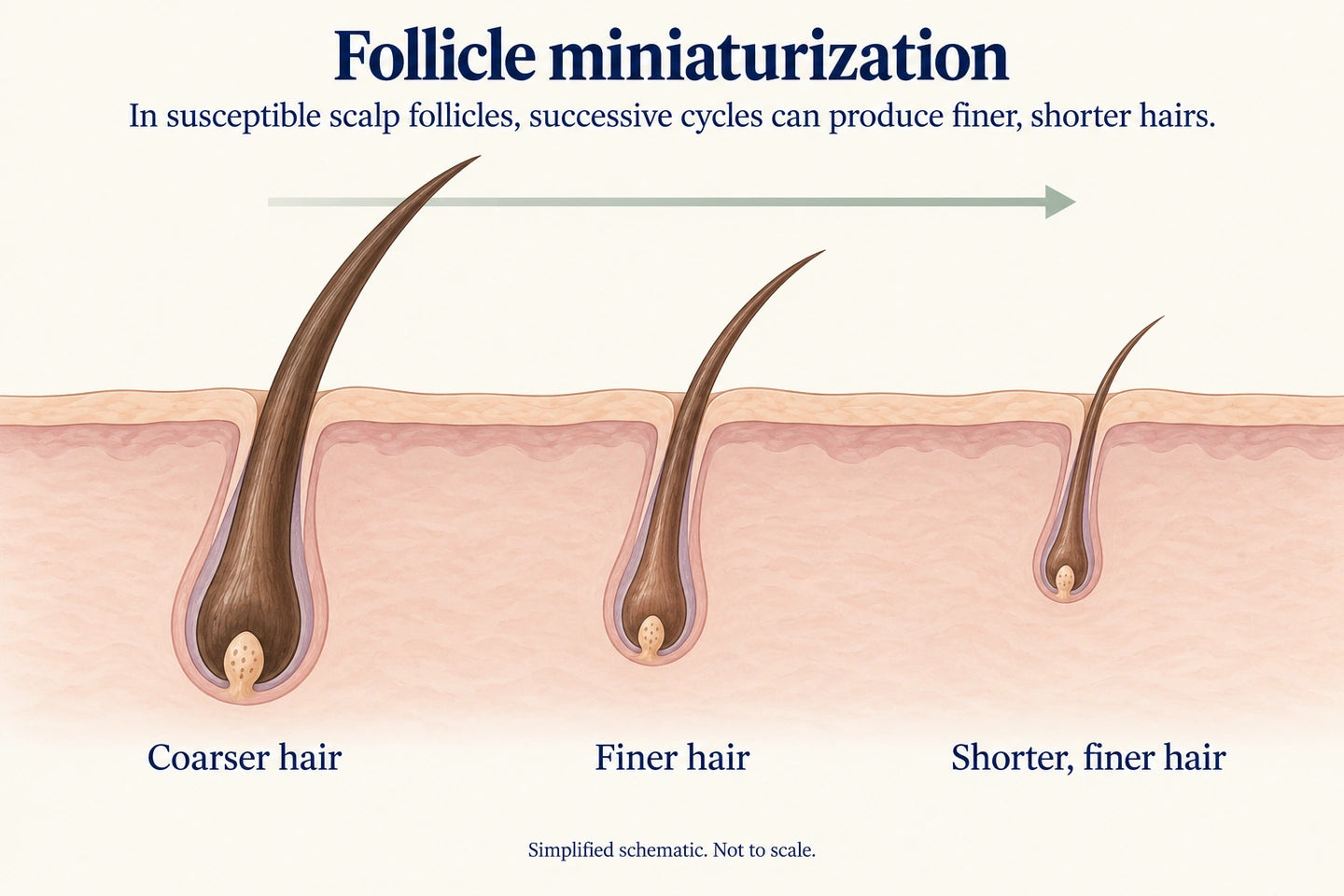 Simplified follicle miniaturization: successive cycles can produce finer, shorter hairs in susceptible scalp follicles. Not to scale.
